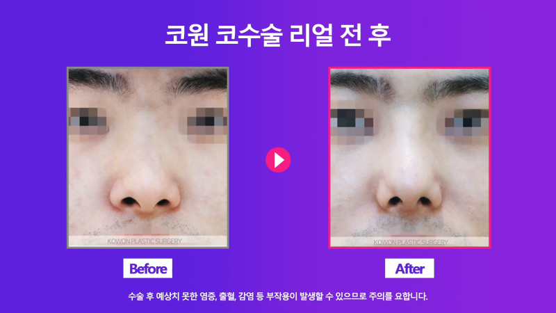 남자휜코 비중격만곡증과 비염의 관계성과 개선을 위한 수술 방법 사진 7