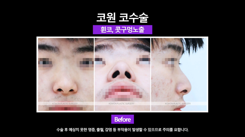 남자휜코 비중격만곡증과 비염의 관계성과 개선을 위한 수술 방법