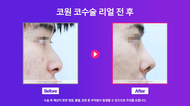 남자휜코 비중격만곡증과 비염의 관계성과 개선을 위한 수술 방법 사진 8