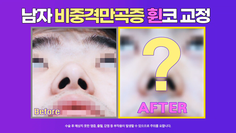 남자휜코 비중격만곡증과 비염의 관계성과 개선을 위한 수술 방법