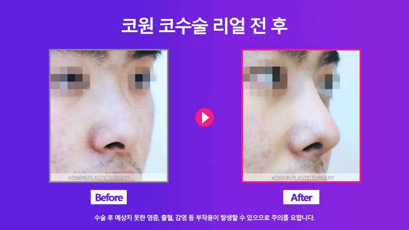 남자휜코 비중격만곡증과 비염의 관계성과 개선을 위한 수술 방법 사진 5