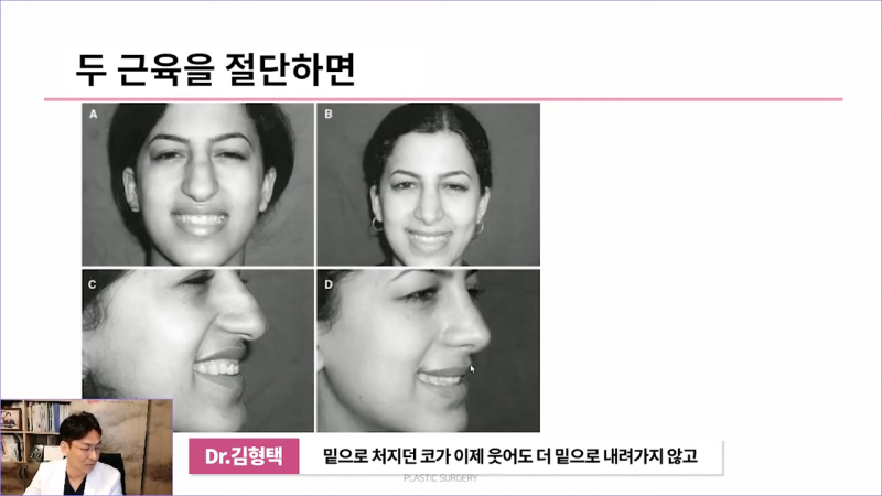 화살코 만드는 근육?! 비중격내림근과 상순비익올림근 절단해야 화살코 해결할 수 있습니다. 사진 12