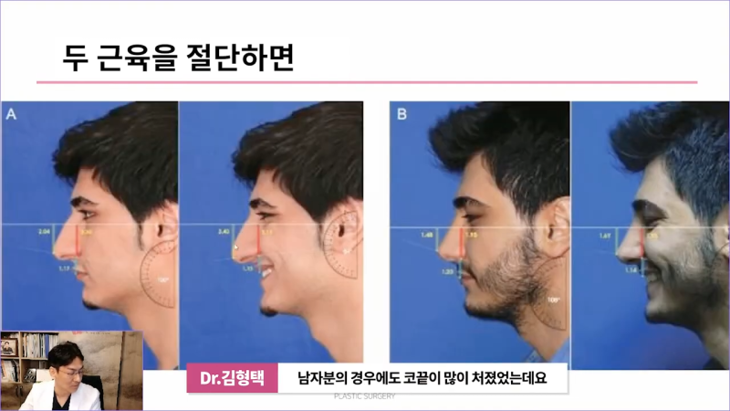 화살코 만드는 근육?! 비중격내림근과 상순비익올림근 절단해야 화살코 해결할 수 있습니다. 사진 14