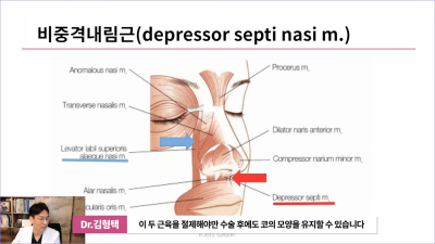 화살코 만드는 근육?! 비중격내림근과 상순비익올림근 절단해야 화살코 해결할 수 있습니다. 사진 11