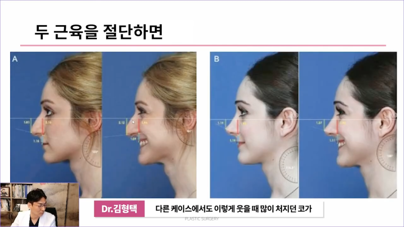 화살코 만드는 근육?! 비중격내림근과 상순비익올림근 절단해야 화살코 해결할 수 있습니다. 사진 13