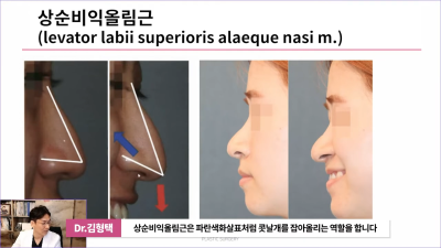화살코 만드는 근육?! 비중격내림근과 상순비익올림근 절단해야 화살코 해결할 수 있습니다. 사진 6