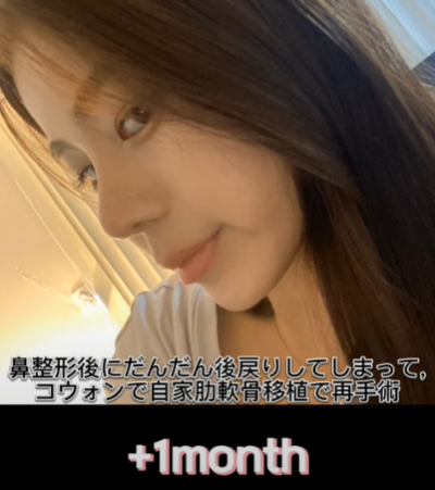 코 재수술에 많이 사용하는 자가늑연골에 대한 모든 것! 장단점은? 사진 21