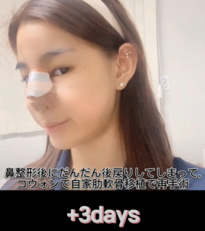 코 재수술에 많이 사용하는 자가늑연골에 대한 모든 것! 장단점은? 사진 18