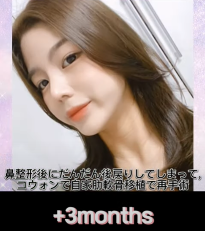 코 재수술에 많이 사용하는 자가늑연골에 대한 모든 것! 장단점은? 사진 23