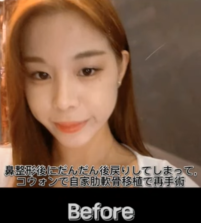 코 재수술에 많이 사용하는 자가늑연골에 대한 모든 것! 장단점은? 사진 17