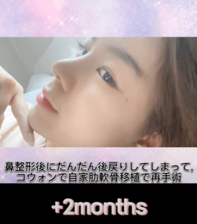 코 재수술에 많이 사용하는 자가늑연골에 대한 모든 것! 장단점은? 사진 22