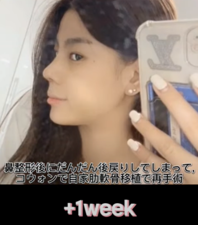 코 재수술에 많이 사용하는 자가늑연골에 대한 모든 것! 장단점은? 사진 19