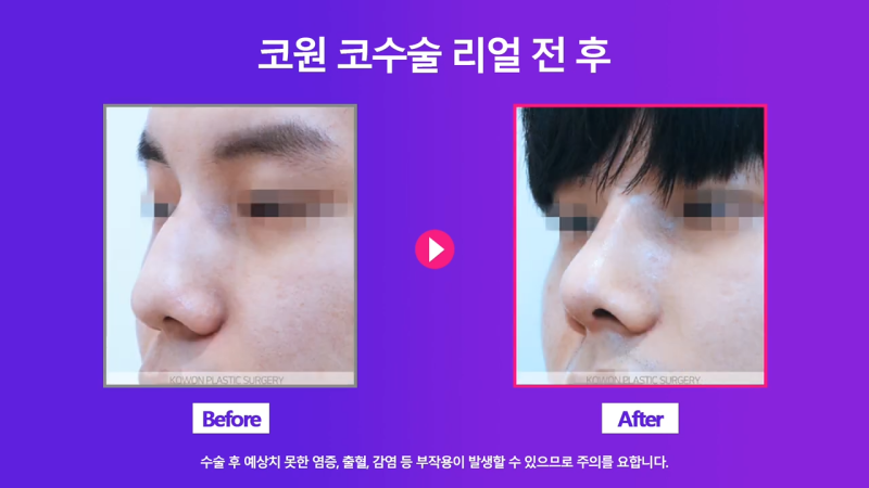 남자매부리코, 휜코교정을 통해 날렵한 코로 개선했습니다. 사진 7