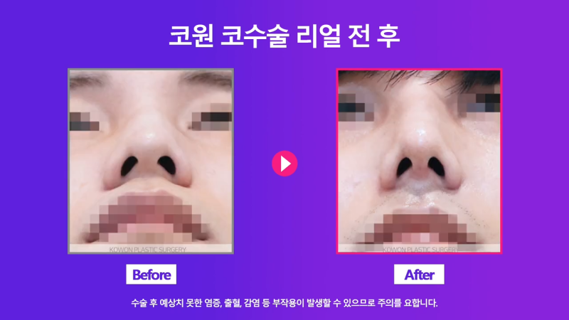 남자매부리코, 휜코교정을 통해 날렵한 코로 개선했습니다. 사진 6