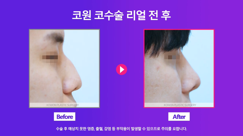 남자매부리코, 휜코교정을 통해 날렵한 코로 개선했습니다. 사진 8