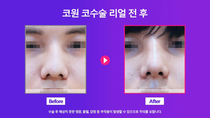 남자매부리코, 휜코교정을 통해 날렵한 코로 개선했습니다. 사진 5