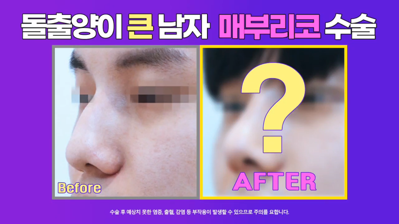 남자매부리코, 휜코교정을 통해 날렵한 코로 개선했습니다.