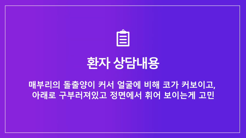 남자매부리코, 휜코교정을 통해 날렵한 코로 개선했습니다.