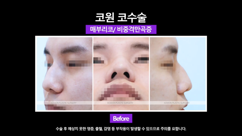 남자매부리코, 휜코교정을 통해 날렵한 코로 개선했습니다. 사진 3