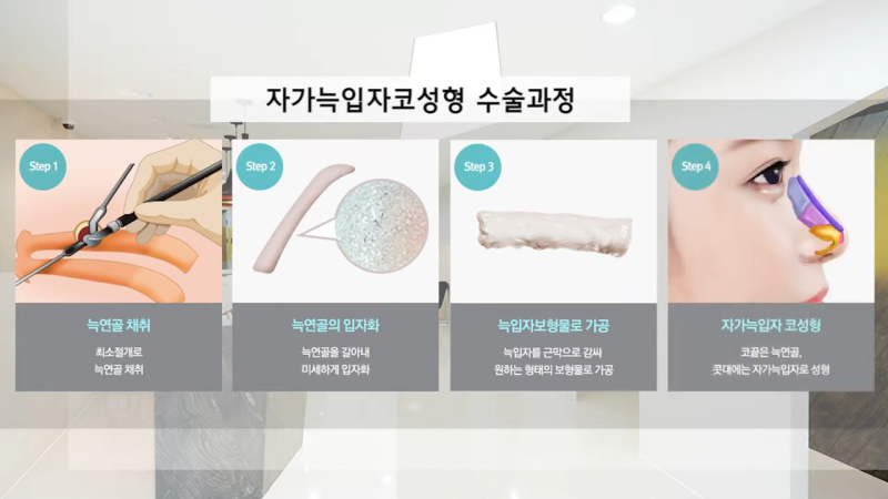 자가늑입자 코성형, 자가조직코수술의 단점을 보완한 것입니다! 사진 6