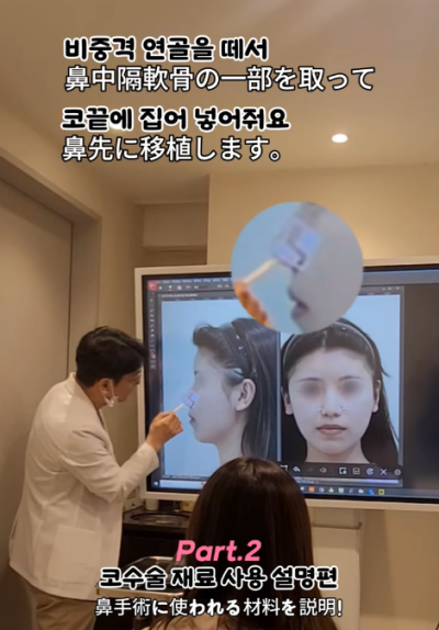 매부리코, 퍼진코 비순각 코수술 후 매끄러워진 콧대 라인! 사진 4