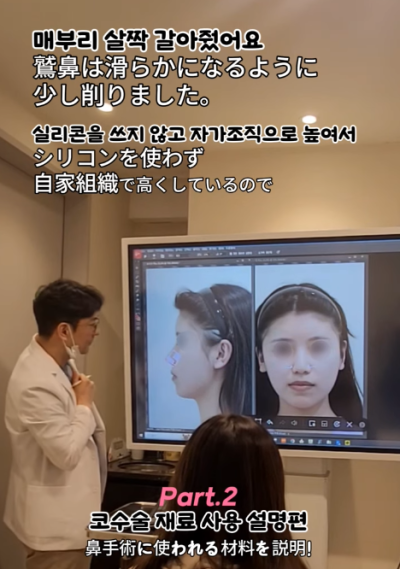 매부리코, 퍼진코 비순각 코수술 후 매끄러워진 콧대 라인! 사진 6