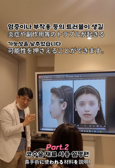 매부리코, 퍼진코 비순각 코수술 후 매끄러워진 콧대 라인! 사진 7