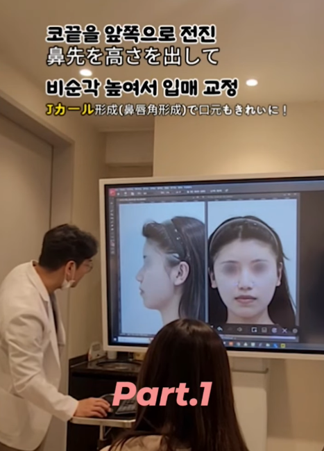 매부리코, 퍼진코 비순각 코수술 후 매끄러워진 콧대 라인! 사진 3