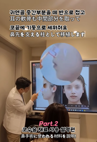 매부리코, 퍼진코 비순각 코수술 후 매끄러워진 콧대 라인! 사진 5