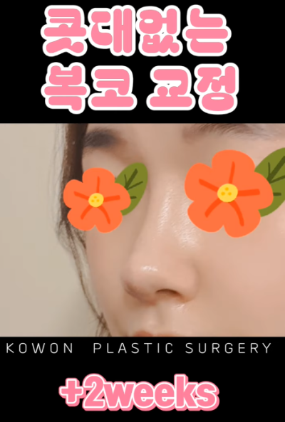 매부리코, 퍼진코 비순각 코수술 후 매끄러워진 콧대 라인! 사진 12