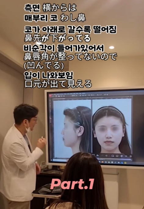 매부리코, 퍼진코 비순각 코수술 후 매끄러워진 콧대 라인!