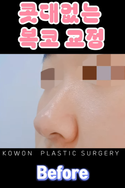 매부리코, 퍼진코 비순각 코수술 후 매끄러워진 콧대 라인! 사진 8