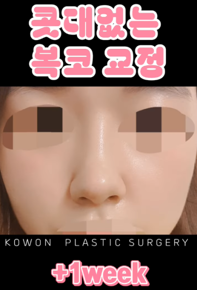 매부리코, 퍼진코 비순각 코수술 후 매끄러워진 콧대 라인! 사진 11