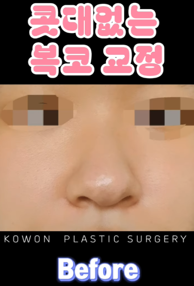 매부리코, 퍼진코 비순각 코수술 후 매끄러워진 콧대 라인! 사진 9