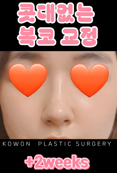 매부리코, 퍼진코 비순각 코수술 후 매끄러워진 콧대 라인! 사진 13