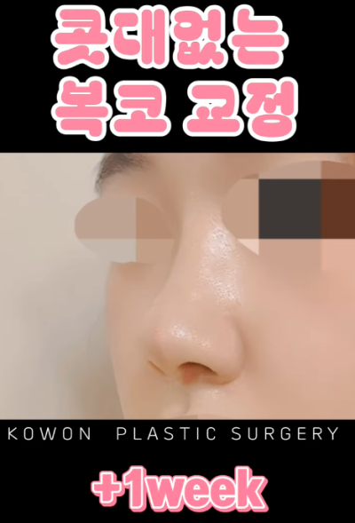 매부리코, 퍼진코 비순각 코수술 후 매끄러워진 콧대 라인! 사진 10