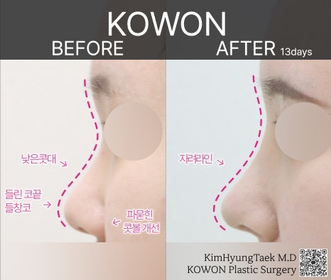 복코성형 정확한 진단으로 원인에 맞는 수술방법으로 개선 - 코원성형외과 사진 8
