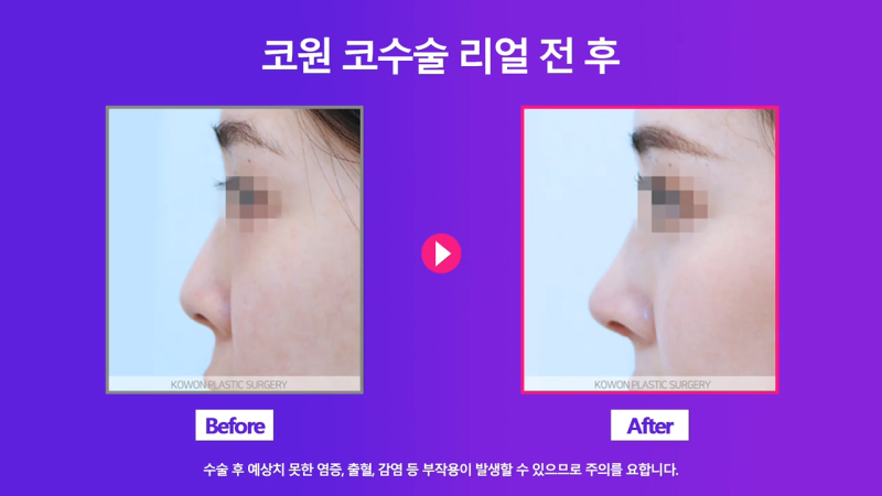 비중격만곡증 있는 짧은코 여성, 교정을 통해 개선 성공했습니다. 사진 8