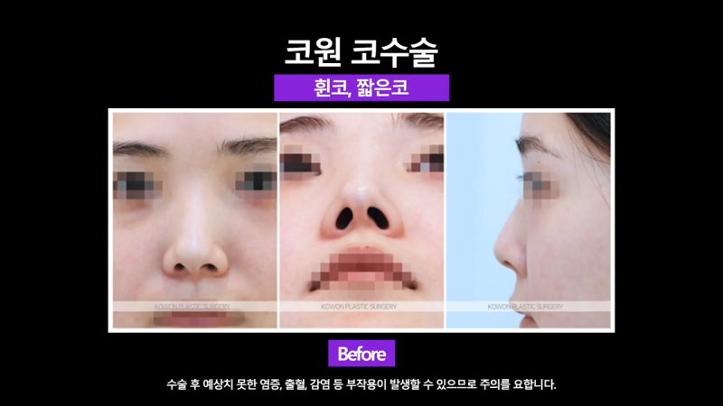 비중격만곡증 있는 짧은코 여성, 교정을 통해 개선 성공했습니다.