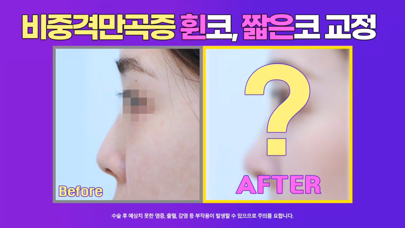 비중격만곡증 있는 짧은코 여성, 교정을 통해 개선 성공했습니다.