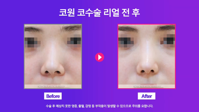 비중격만곡증 있는 짧은코 여성, 교정을 통해 개선 성공했습니다. 사진 5