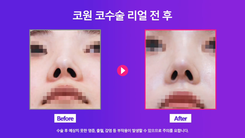 비중격만곡증 있는 짧은코 여성, 교정을 통해 개선 성공했습니다. 사진 6