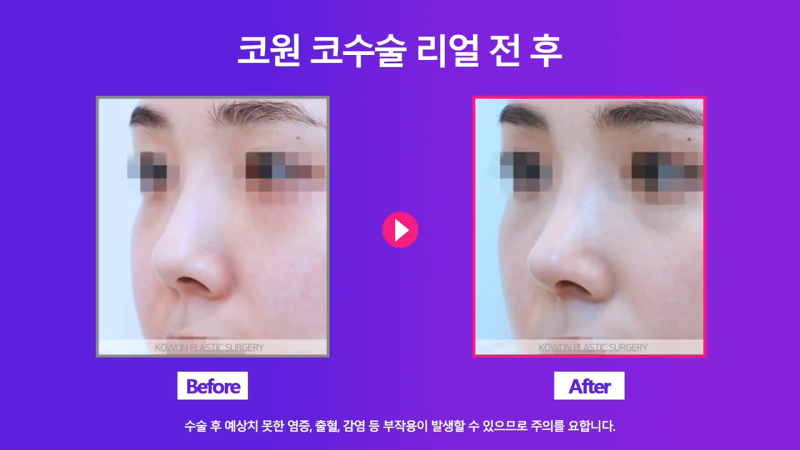 비중격만곡증 있는 짧은코 여성, 교정을 통해 개선 성공했습니다. 사진 7