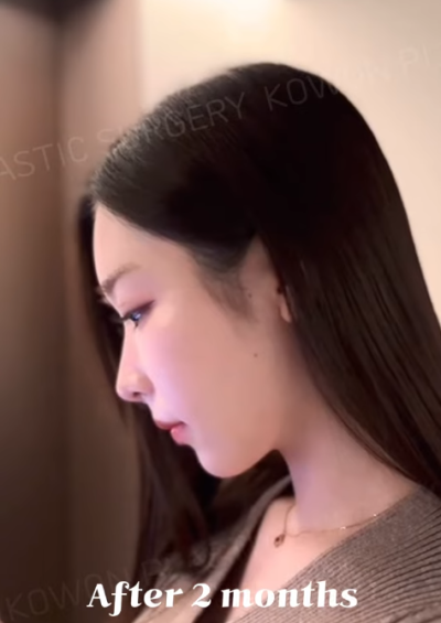 낮은코수술, 코끝 교정으로 개선 성공! 사진 후기 사진 8