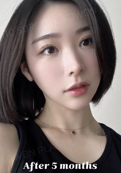 낮은코수술, 코끝 교정으로 개선 성공! 사진 후기 사진 10