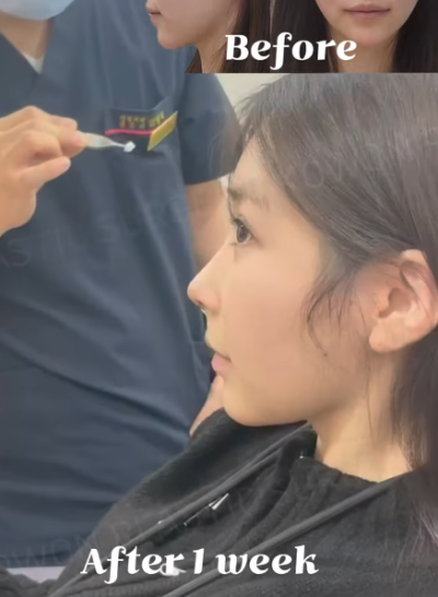 낮은코수술, 코끝 교정으로 개선 성공! 사진 후기 사진 7