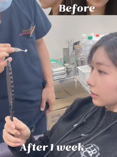 낮은코수술, 코끝 교정으로 개선 성공! 사진 후기 사진 4