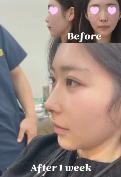 낮은코수술, 코끝 교정으로 개선 성공! 사진 후기 사진 6