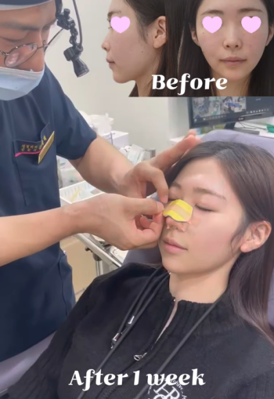 낮은코수술, 코끝 교정으로 개선 성공! 사진 후기