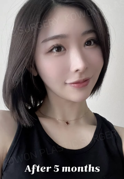 낮은코수술, 코끝 교정으로 개선 성공! 사진 후기 사진 11